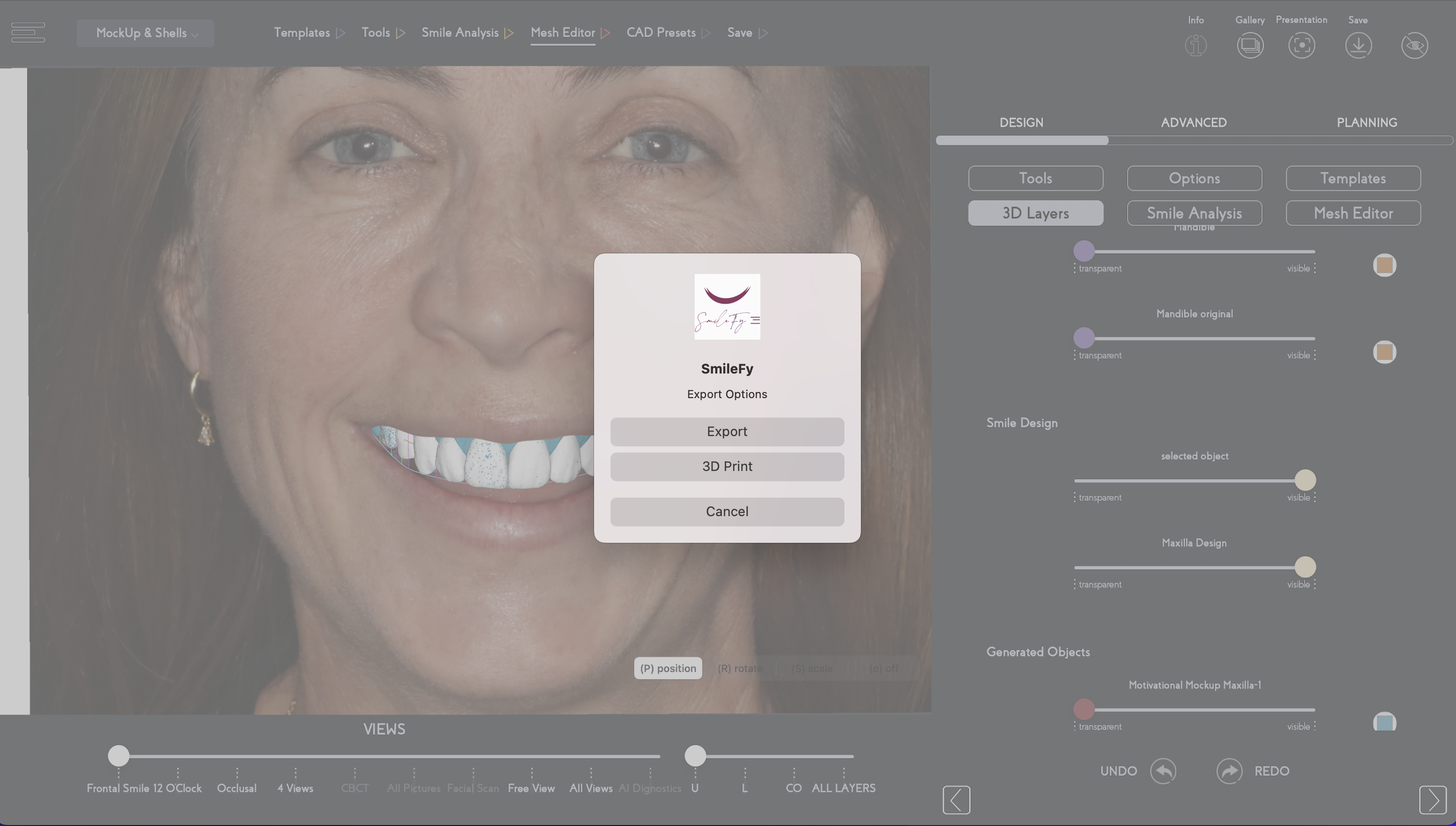Printed Models + in-mouth Smile Trial: A silicone key was fabricated to create a mock-up out of bis-acryl resin. The mock-up was placed onto the patient’s teeth, and when shown to her, she expressed how satisfied she was with the aesthetics and natural look of her new smile.